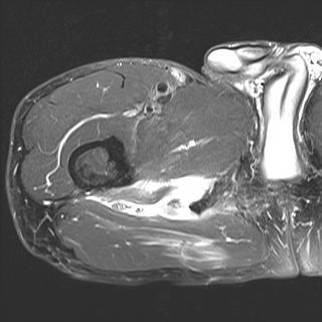 Proximal Hamstring Avulsion MRI Axial
